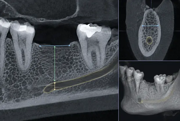 3D CT 단면 이미지 — 잇몸뼈 높이·두께 계측선 표시